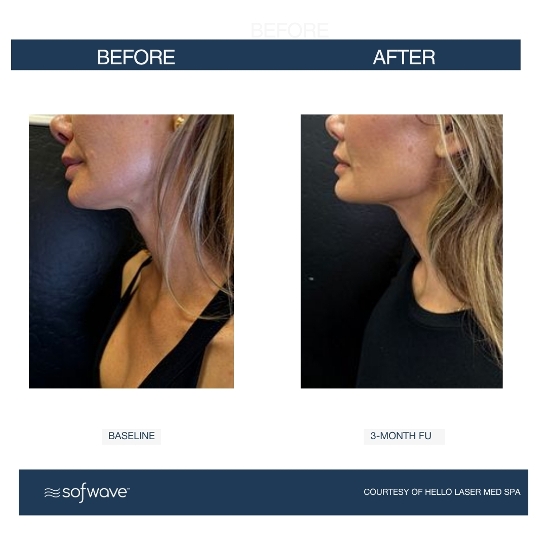 Before and After Image: Before and After Photos: Sofwave - left-side