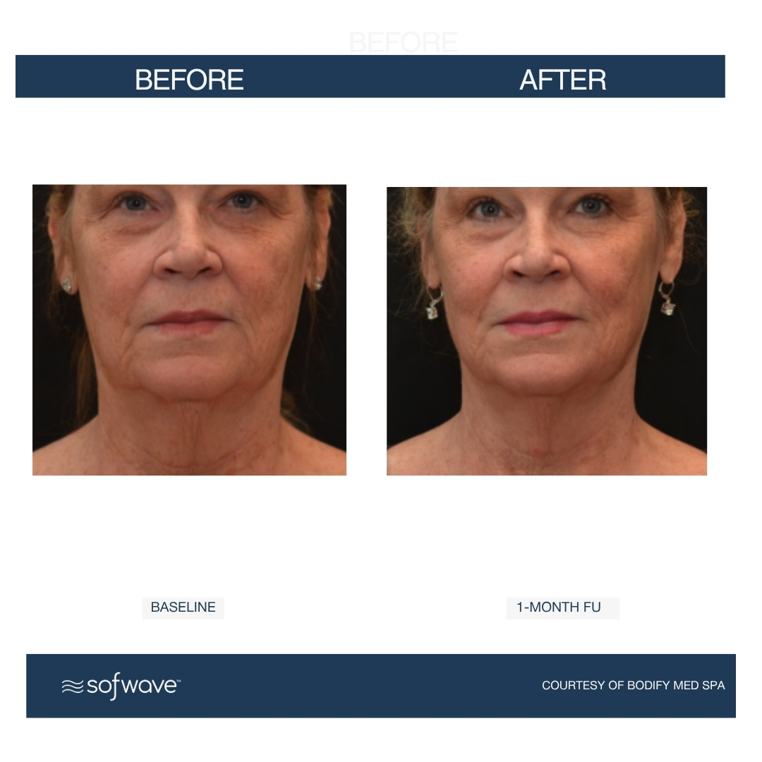 Before and After Image: Before and After Photos: Sofwave - front