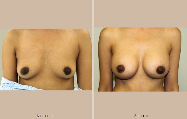 breast breast augmentation 1356113754781