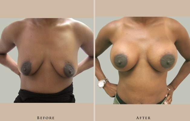 breast breast augmentation 1447019480546