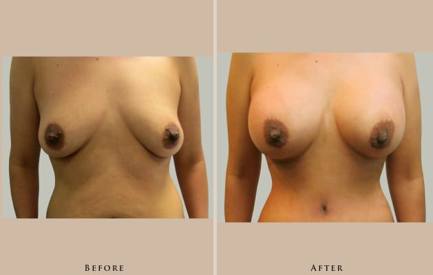 breast breast augmentation 1447252769266