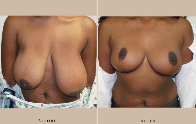 breast breast augmentation and lift 1372434931178