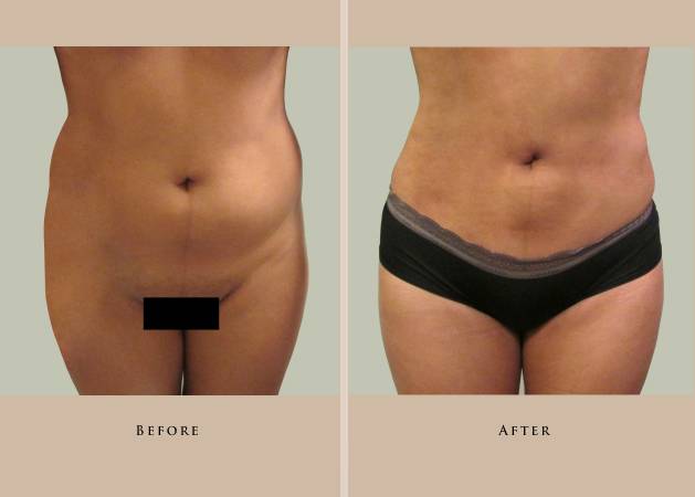 body liposuction 1387307916955 front