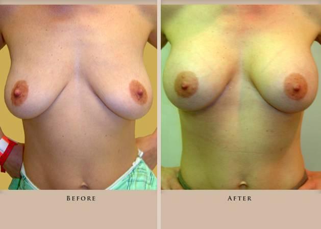 breast augmentation p03 front lg