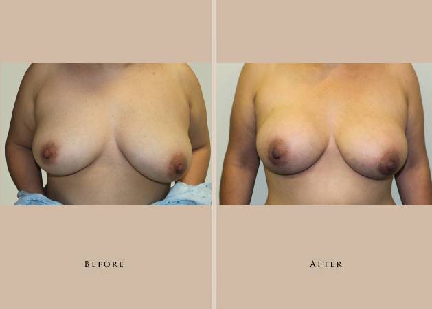 breast breast augmentation 1372436266591
