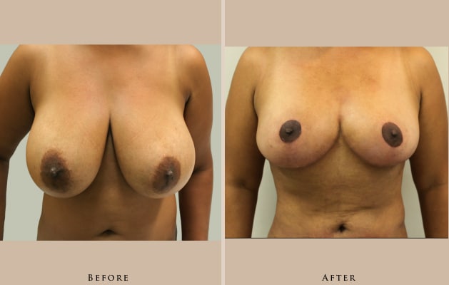 breast breast reduction 1387302991646