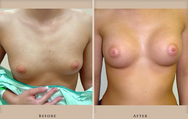 breast augmentation p01 front lg
