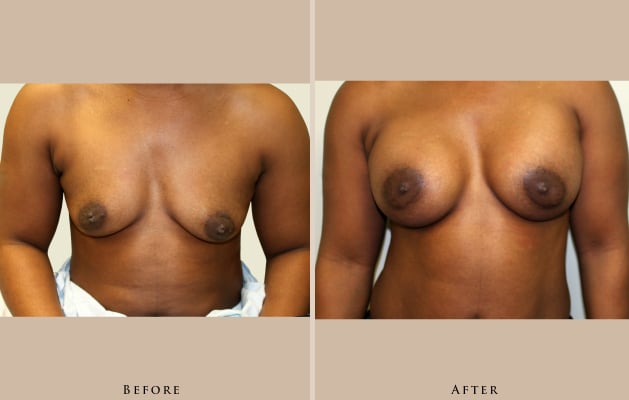 breast breast augmentation 1367460057058