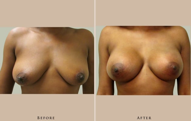 breast breast augmentation 1414544313166