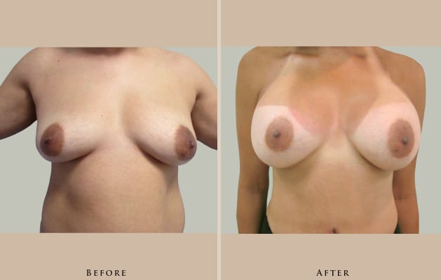 breast breast augmentation 1447022783018