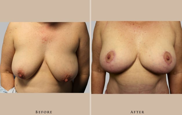 breast breast augmentation and lift 1372370272166