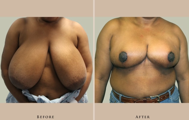 breast breast reduction 1372435456958