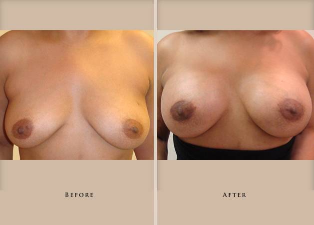 breast augmentation p05 front lg