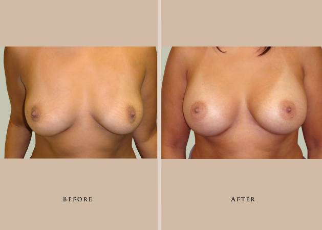 breast breast augmentation 1337913304932
