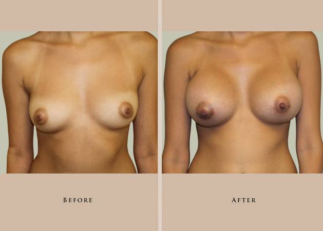 breast breast augmentation 1372437619299