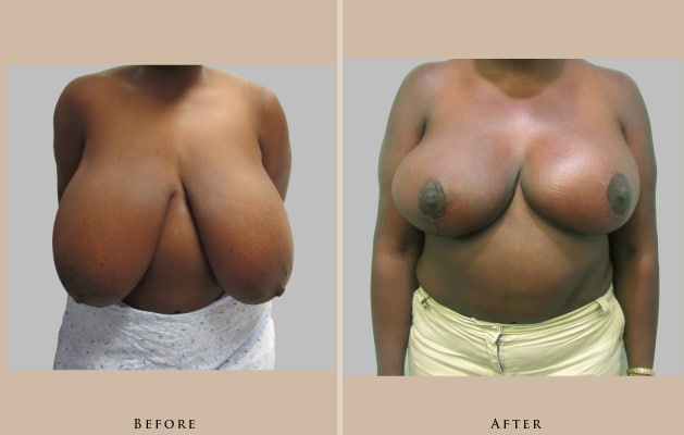 breast breast reduction 1446837600608