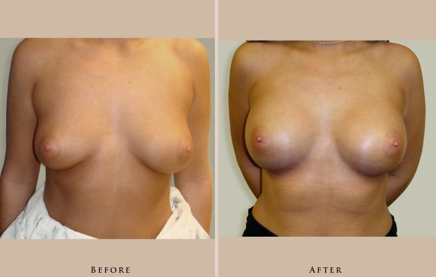 breast augmentation case06 front lg