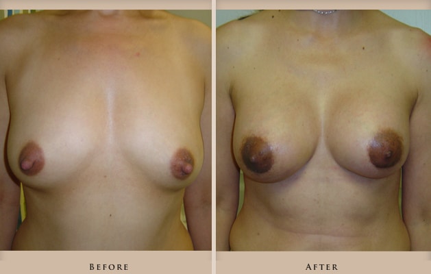 breast augmentation p02 front lg