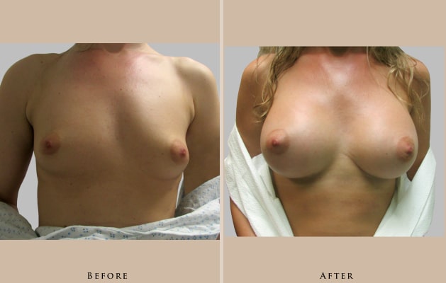 breast breast augmentation 1429109866692
