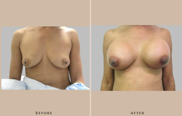 breast breast augmentation 1442801569525