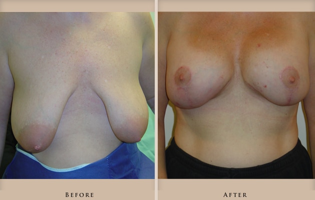 breast lift augmentation p01 front lg