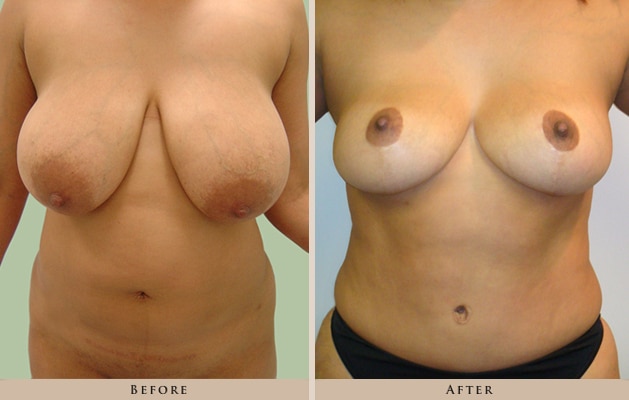 breast reduction p04 front lg
