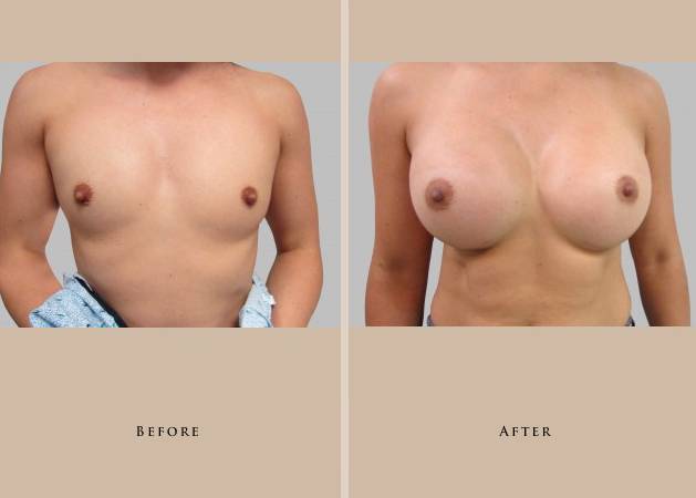 breast augmentation intro