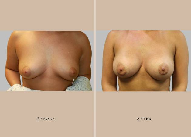 breast breast augmentation 1351203249215