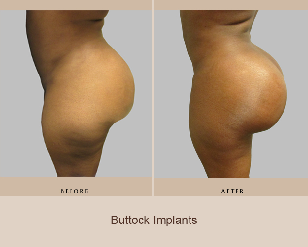 Buttock Implants - Sanjay Lalla, MD