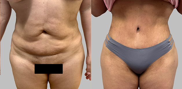 Before and After Image: Before and After Photos: Abdominoplasty (Tummy Tuck) - front