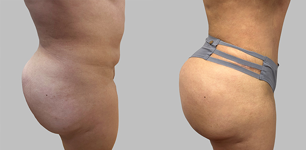 Before and After Image: Before and After Photos: Abdominoplasty (Tummy Tuck) - right-side