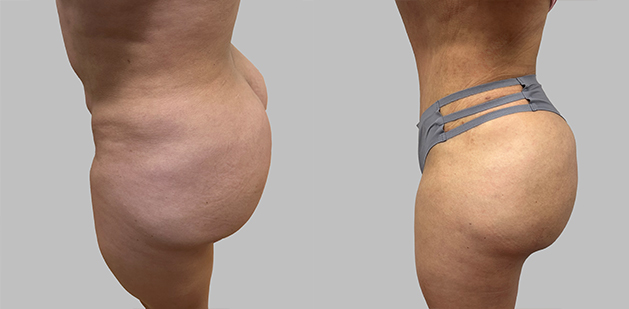 Before and After Image: Before and After Photos: Abdominoplasty (Tummy Tuck) - left-side