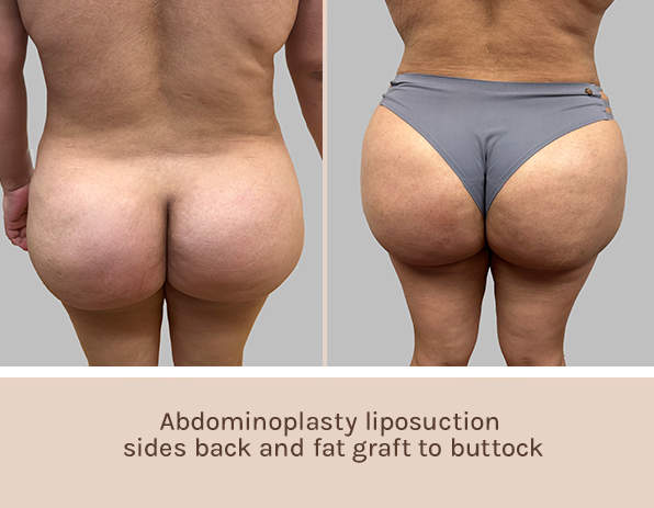 Before and After Image: Before and After Photos: Abdominoplasty (Tummy Tuck) - back