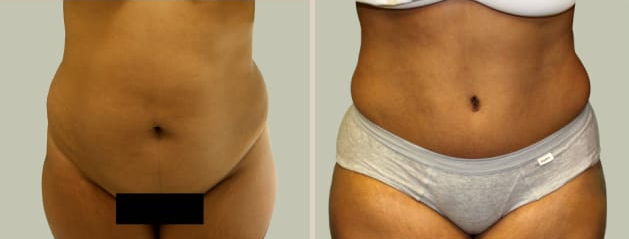 Before and After Image: Before and After Photos: Abdominoplasty (Tummy Tuck) - front