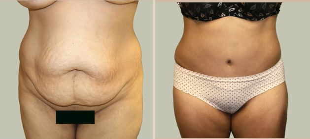 Before and After Image: Before and After Photos: Abdominoplasty (Tummy Tuck) - front