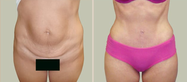 Before and After Image: Before and After Photos: Abdominoplasty (Tummy Tuck) - front