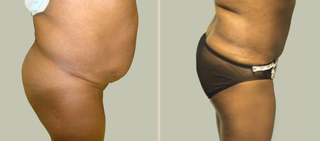 Before and After Image: Before and After Photos: Abdominoplasty (Tummy Tuck) - right-side