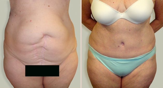 Before and After Image: Before and After Photos: Abdominoplasty (Tummy Tuck) - front