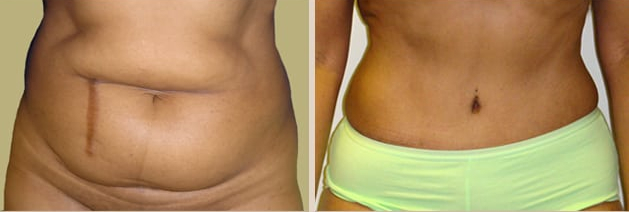 Before and After Image: Before and After Photos: Abdominoplasty (Tummy Tuck) - front