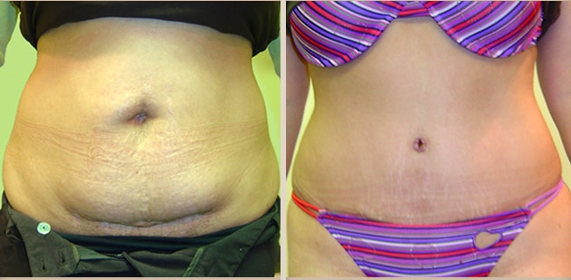Before and After Image: Before and After Photos: Abdominoplasty (Tummy Tuck) - front