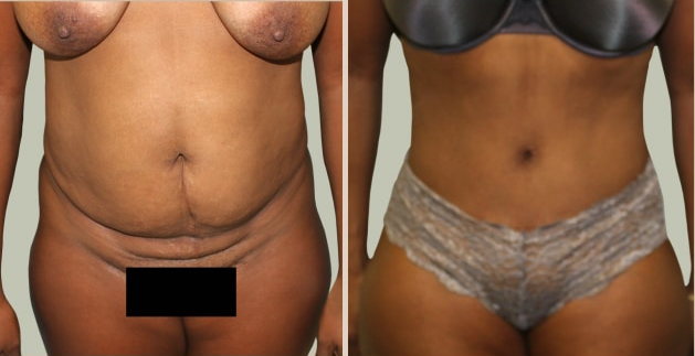 Before and After Image: Before and After Photos: Abdominoplasty (Tummy Tuck) - front