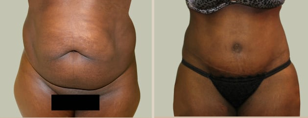 Before and After Image: Before and After Photos: Abdominoplasty (Tummy Tuck) - front