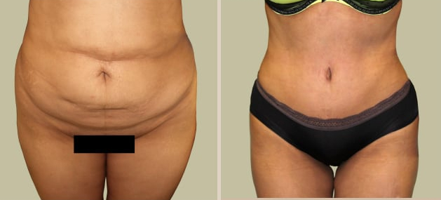 Before and After Image: Before and After Photos: Abdominoplasty (Tummy Tuck) - front