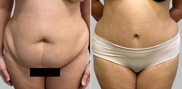 Before and After Image: Before and After Photos: Abdominoplasty (Tummy Tuck) - front