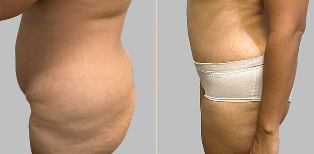 Before and After Image: Before and After Photos: Abdominoplasty (Tummy Tuck) - left-side