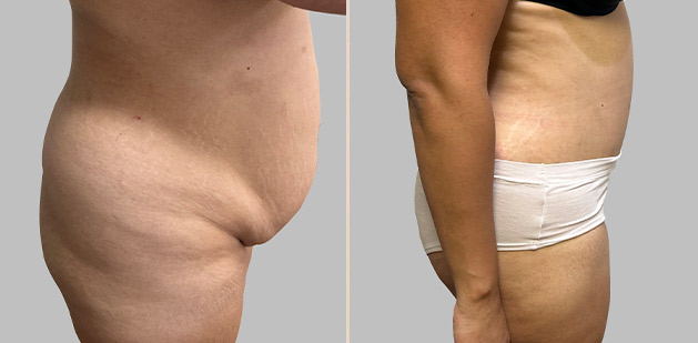 Before and After Image: Before and After Photos: Abdominoplasty (Tummy Tuck) - right-side