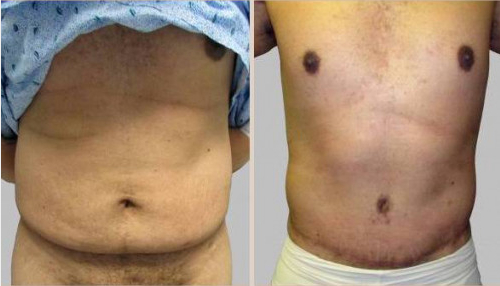 Before and After Image: Before and After Photos: Abdominoplasty (Tummy Tuck) - front