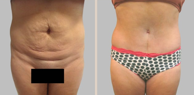 Before and After Image: Before and After Photos: Abdominoplasty (Tummy Tuck) - front
