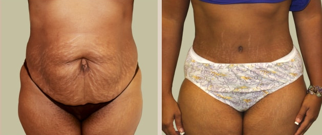 Before and After Image: Before and After Photos: Abdominoplasty (Tummy Tuck) - front