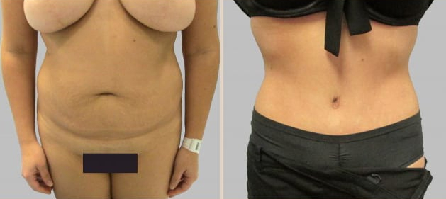 Before and After Image: Before and After Photos: Abdominoplasty (Tummy Tuck) - front